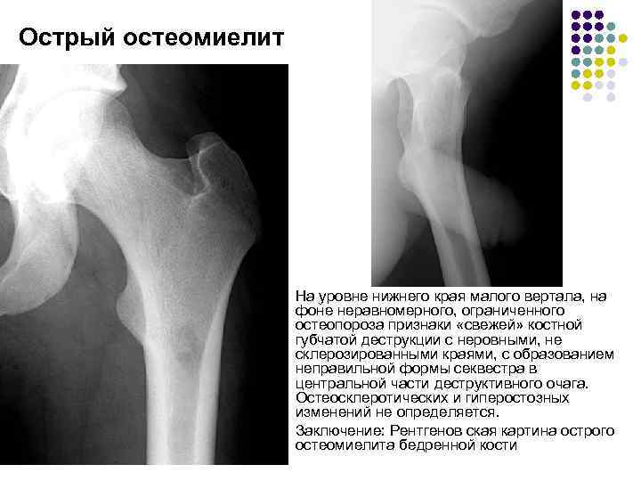 Острый остеомиелит l l На уровне нижнего края малого вертала, на фоне неравномерного, ограниченного