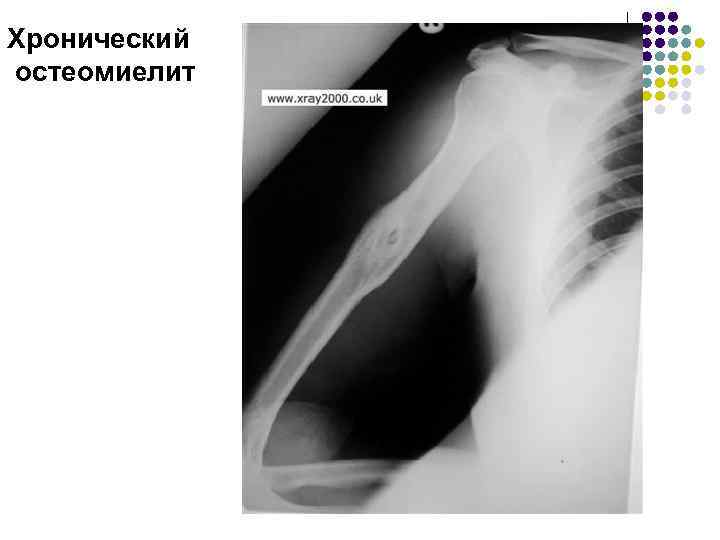 Хронический остеомиелит 