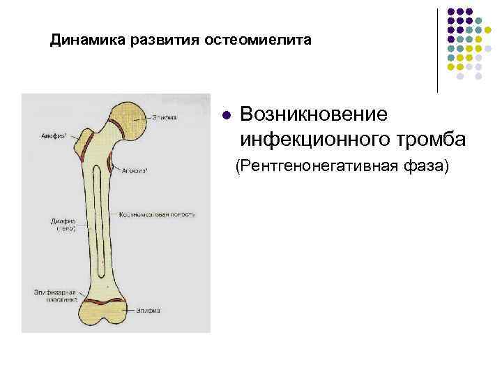 Динамика развития остеомиелита l Возникновение инфекционного тромба (Рентгенонегативная фаза) 