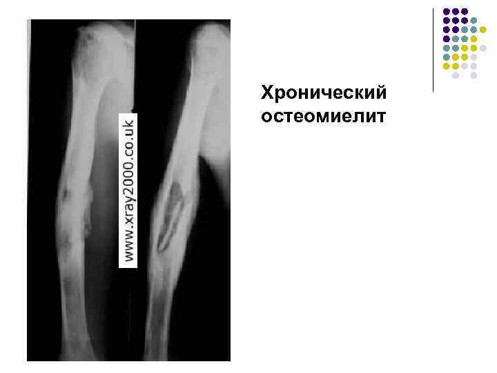 Хронический остеомиелит 