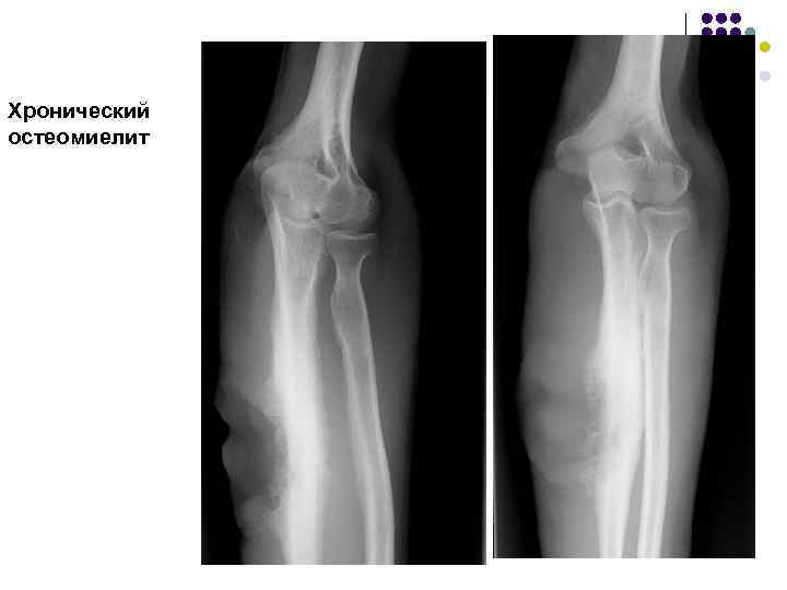 Хронический остеомиелит картинки