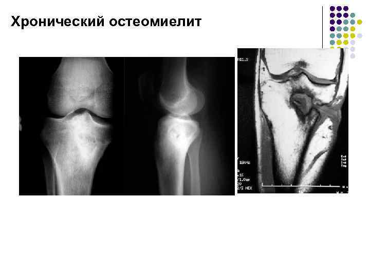 Хронический остеомиелит картинки