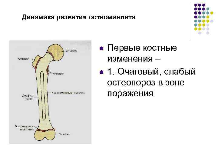 Динамика развития остеомиелита l l Первые костные изменения – 1. Очаговый, слабый остеопороз в