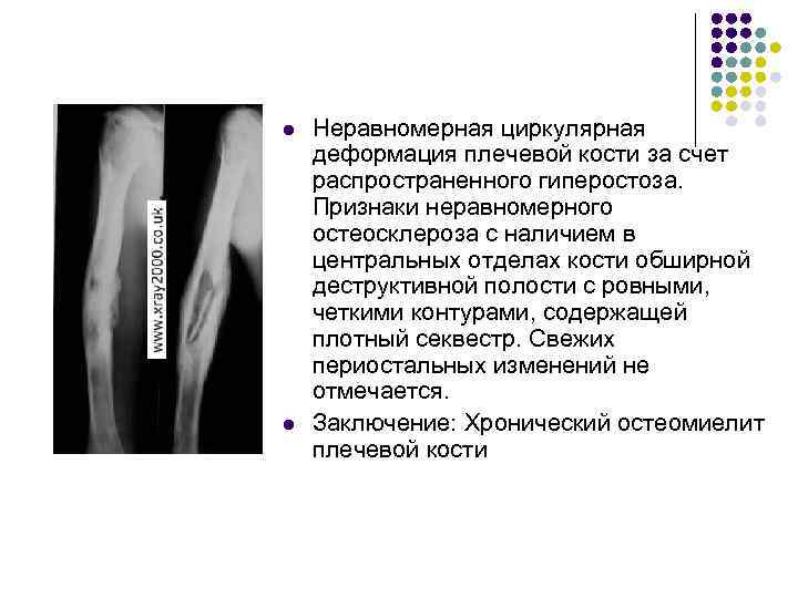l l Неравномерная циркулярная деформация плечевой кости за счет распространенного гиперостоза. Признаки неравномерного остеосклероза