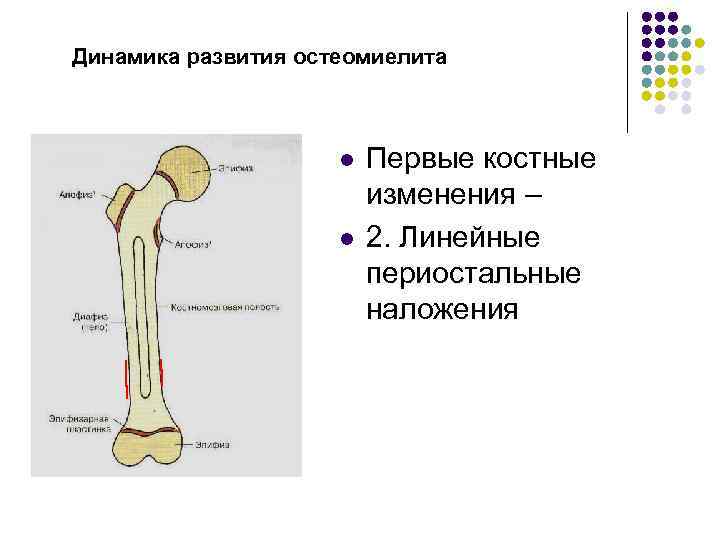 Динамика развития остеомиелита l l Первые костные изменения – 2. Линейные периостальные наложения 