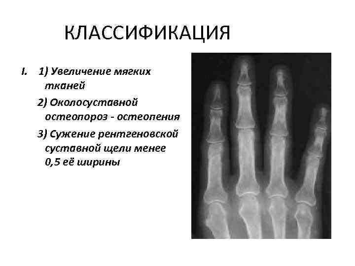 КЛАССИФИКАЦИЯ I. 1) Увеличение мягких тканей 2) Околосуставной остеопороз - остеопения 3) Сужение рентгеновской