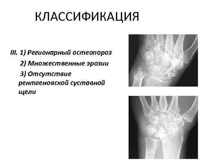 КЛАССИФИКАЦИЯ III. 1) Регионарный остеопороз 2) Множественные эрозии 3) Отсутствие рентгеновской суставной щели 