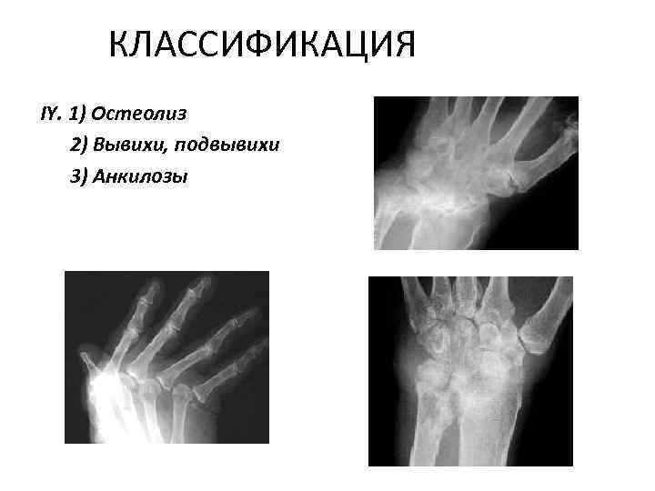 КЛАССИФИКАЦИЯ IY. 1) Остеолиз 2) Вывихи, подвывихи 3) Анкилозы 