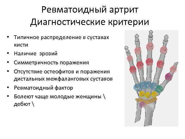 Ревматоидный артрит Диагностические критерии • Типичное распределение в суставах кисти • Наличие эрозий •