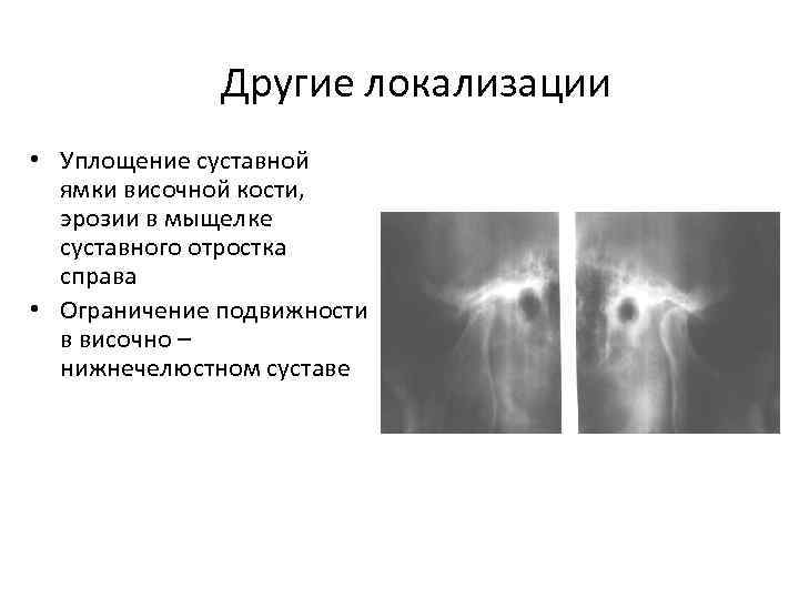 Другие локализации • Уплощение суставной ямки височной кости, эрозии в мыщелке суставного отростка справа