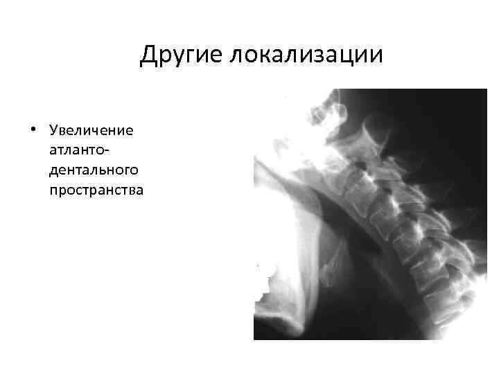 Другие локализации • Увеличение атлантодентального пространства 