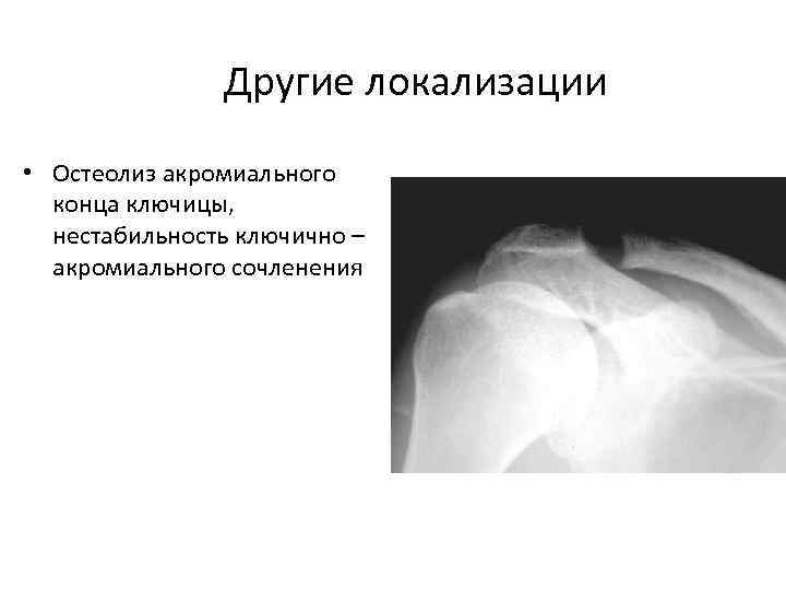 Другие локализации • Остеолиз акромиального конца ключицы, нестабильность ключично – акромиального сочленения 