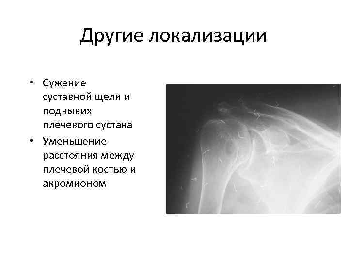 Другие локализации • Сужение суставной щели и подвывих плечевого сустава • Уменьшение расстояния между