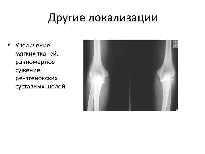 Другие локализации • Увеличение мягких тканей, равномерное сужение рентгеновских суставных щелей 