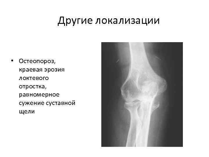 Другие локализации • Остеопороз, краевая эрозия локтевого отростка, равномерное сужение суставной щели 