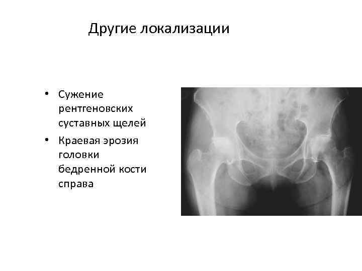 Другие локализации • Сужение рентгеновских суставных щелей • Краевая эрозия головки бедренной кости справа