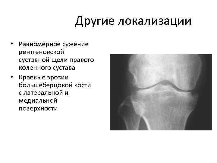 Другие локализации • Равномерное сужение рентгеновской суставной щели правого коленного сустава • Краевые эрозии