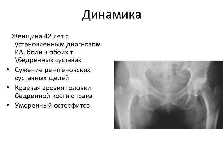 Динамика Женщина 42 лет с установленным диагнозом РА, боли в обоих т бедренных суставах