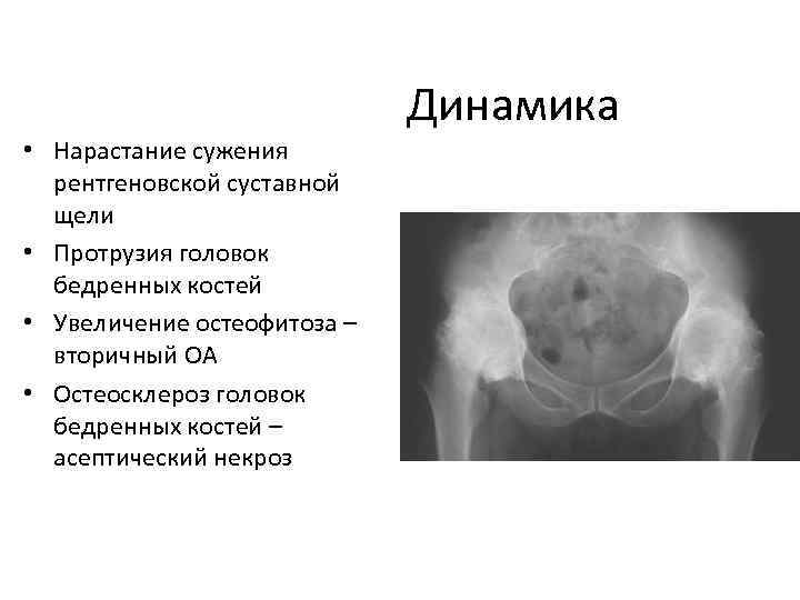 Динамика • Нарастание сужения рентгеновской суставной щели • Протрузия головок бедренных костей • Увеличение