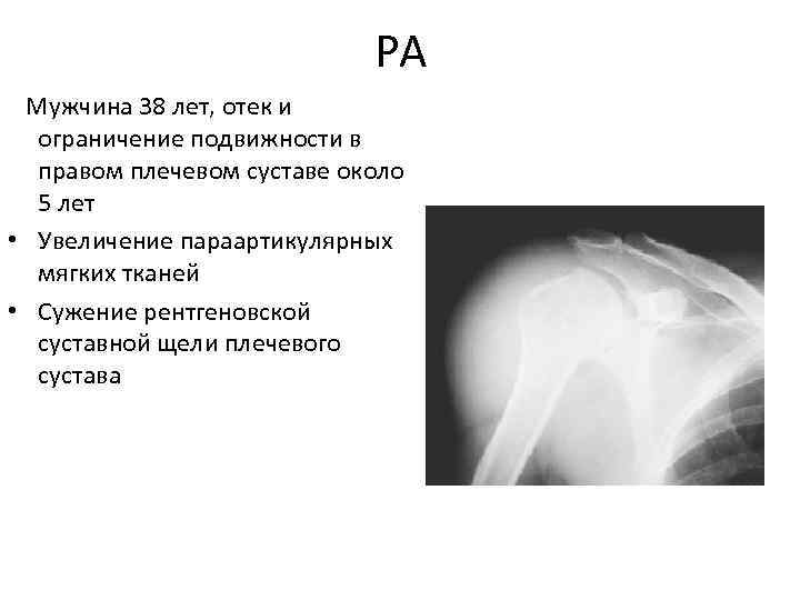 РА Мужчина 38 лет, отек и ограничение подвижности в правом плечевом суставе около 5