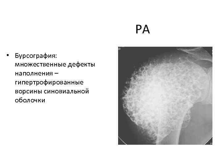 РА • Бурсография: множественные дефекты наполнения – гипертрофированные ворсины синовиальной оболочки 