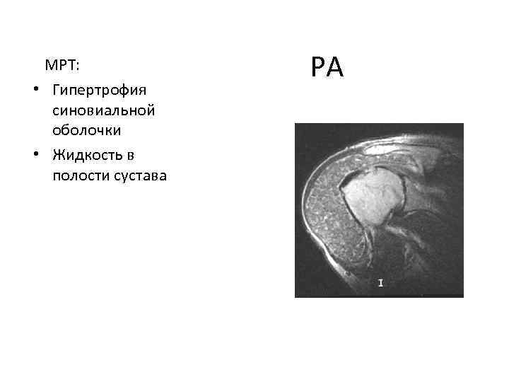 МРТ: • Гипертрофия синовиальной оболочки • Жидкость в полости сустава РА 
