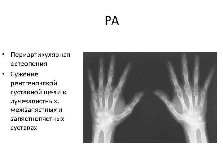 РА • Периартикулярная остеопения • Сужение рентгеновской суставной щели в лучезапястных, межзапястных и запястнопястных