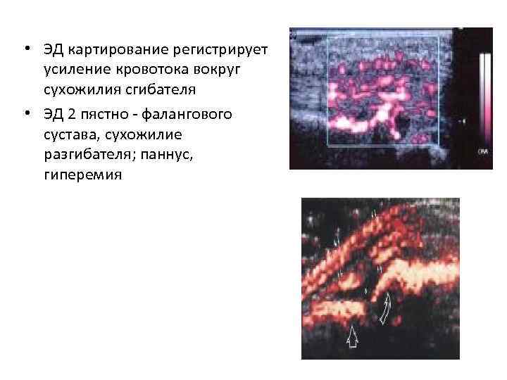  • ЭД картирование регистрирует усиление кровотока вокруг сухожилия сгибателя • ЭД 2 пястно