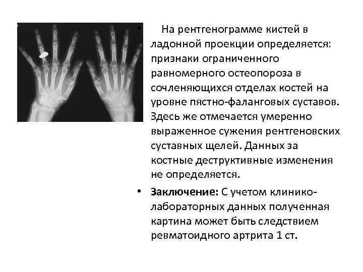 На рентгенограмме кистей в ладонной проекции определяется: признаки ограниченного равномерного остеопороза в сочленяющихся отделах