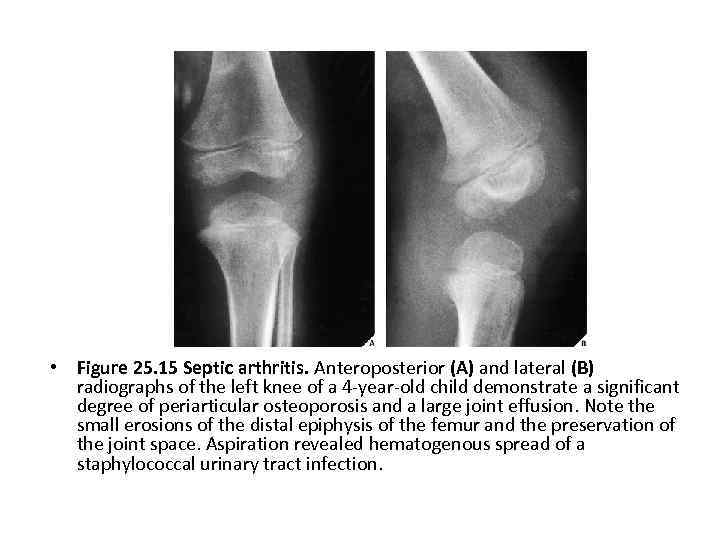  • Figure 25. 15 Septic arthritis. Anteroposterior (A) and lateral (B) radiographs of