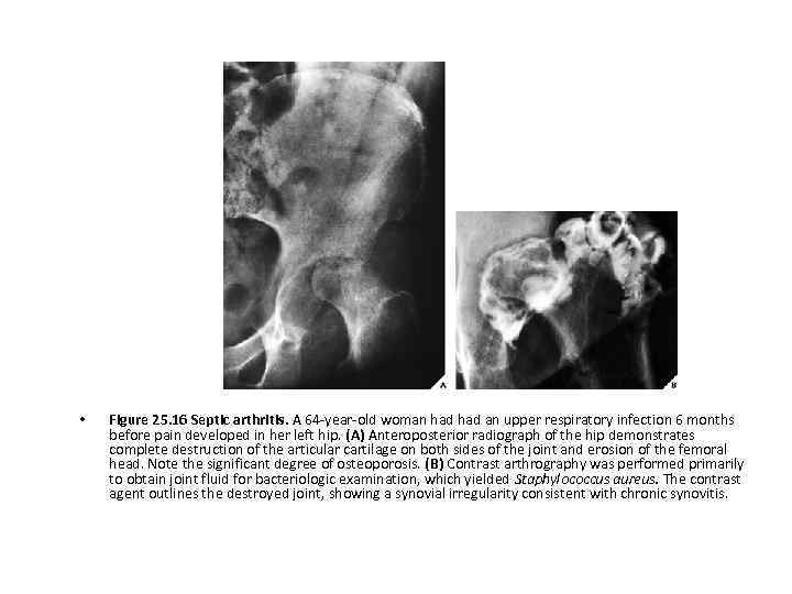  • Figure 25. 16 Septic arthritis. A 64 -year-old woman had an upper