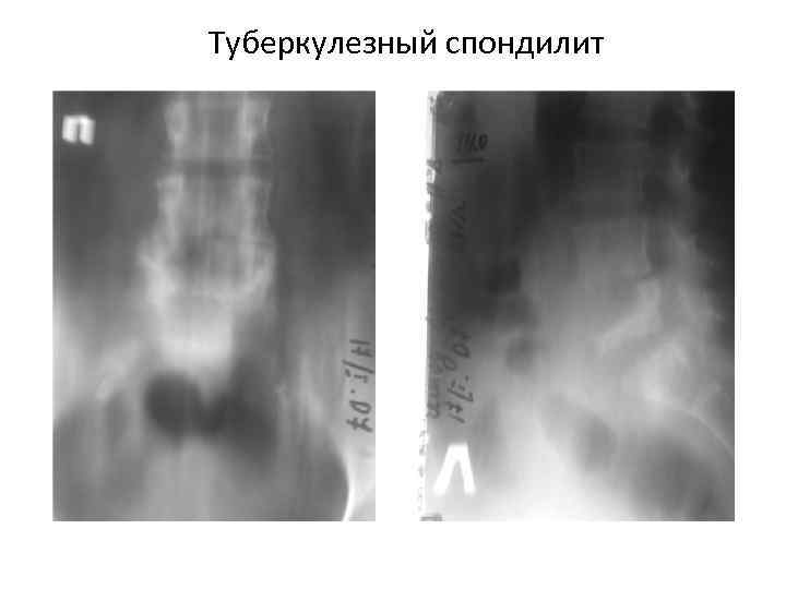 Туберкулезный спондилит 