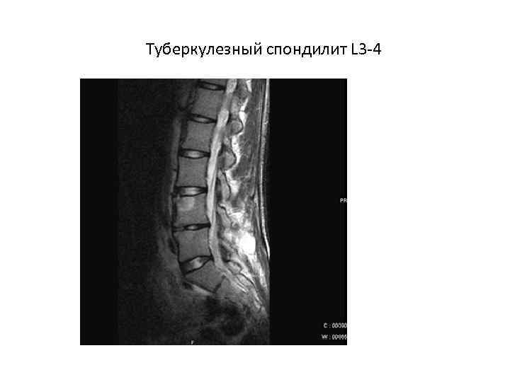 Туберкулезный спондилит L 3 -4 