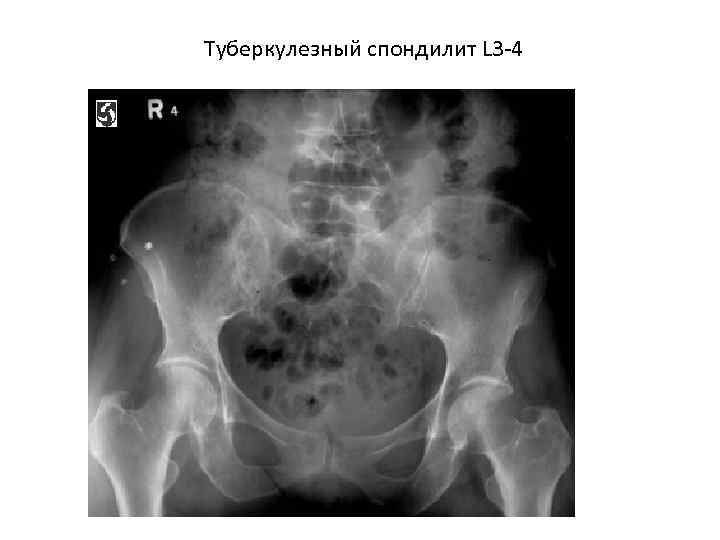 Туберкулезный спондилит L 3 -4 