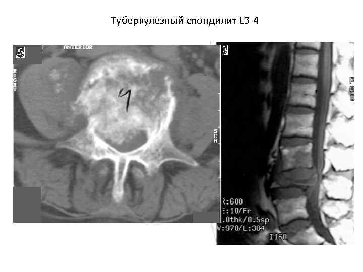 Туберкулезный спондилит L 3 -4 