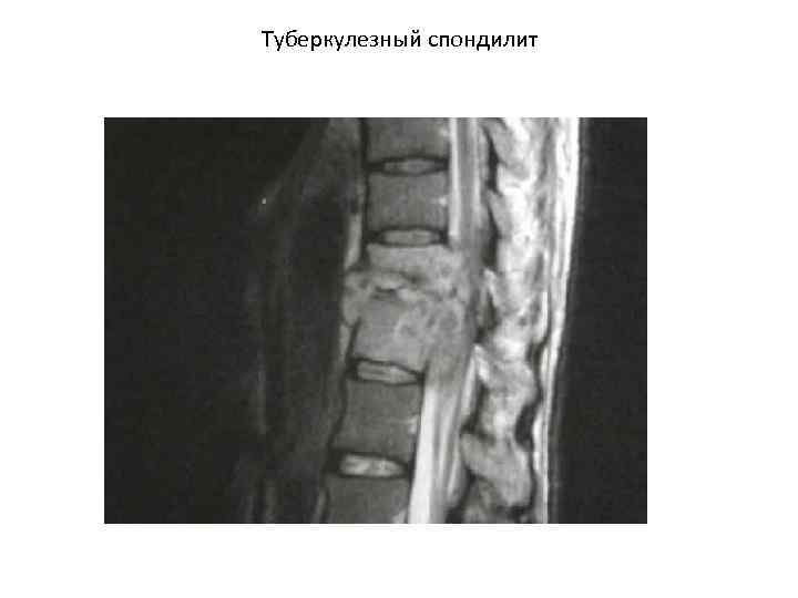 Туберкулезный спондилит 