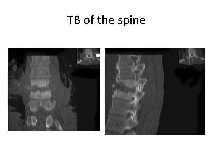 TB of the spine 