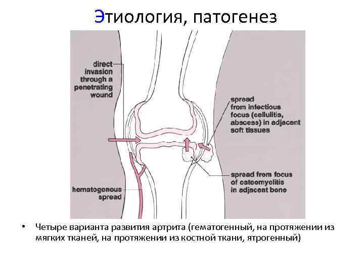 Этиология, патогенез • Четыре варианта развития артрита (гематогенный, на протяжении из мягких тканей, на