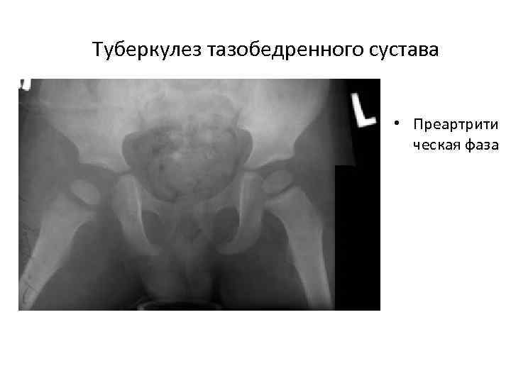 Туберкулез тазобедренного сустава • Преартрити ческая фаза 