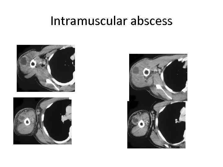 Intramuscular abscess 