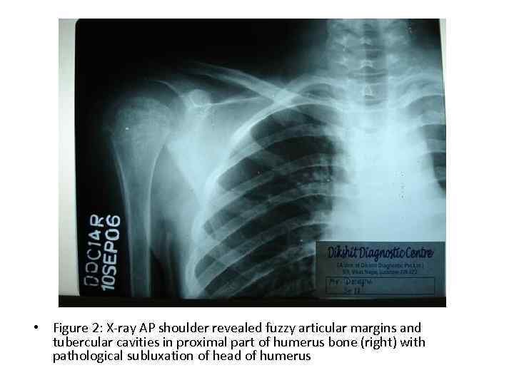  • Figure 2: X-ray AP shoulder revealed fuzzy articular margins and tubercular cavities