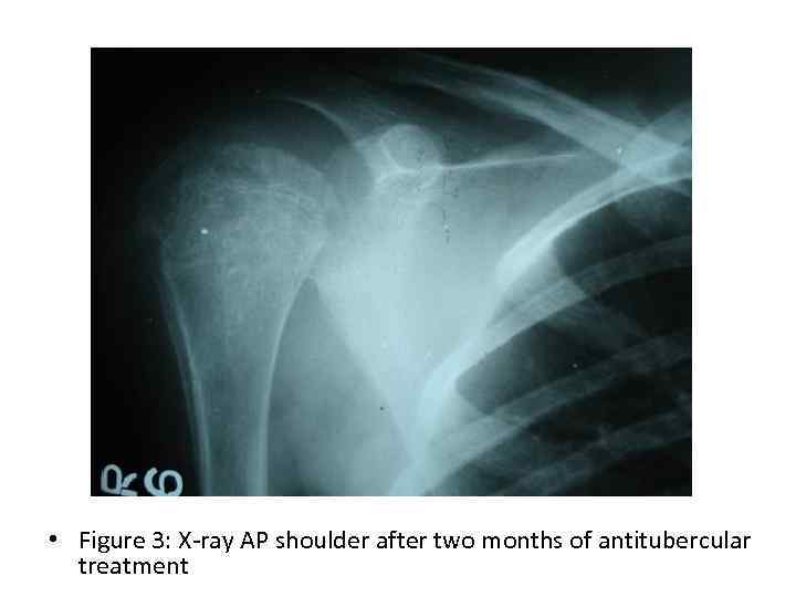  • Figure 3: X-ray AP shoulder after two months of antitubercular treatment 