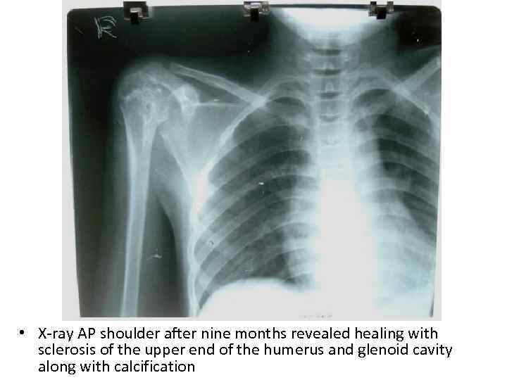  • X-ray AP shoulder after nine months revealed healing with sclerosis of the