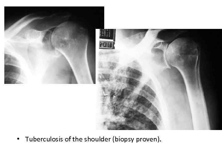  • Tuberculosis of the shoulder (biopsy proven). 