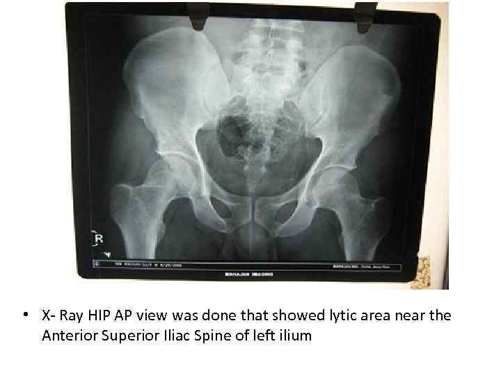  • X- Ray HIP AP view was done that showed lytic area near