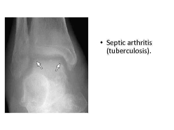  • Septic arthritis (tuberculosis). 