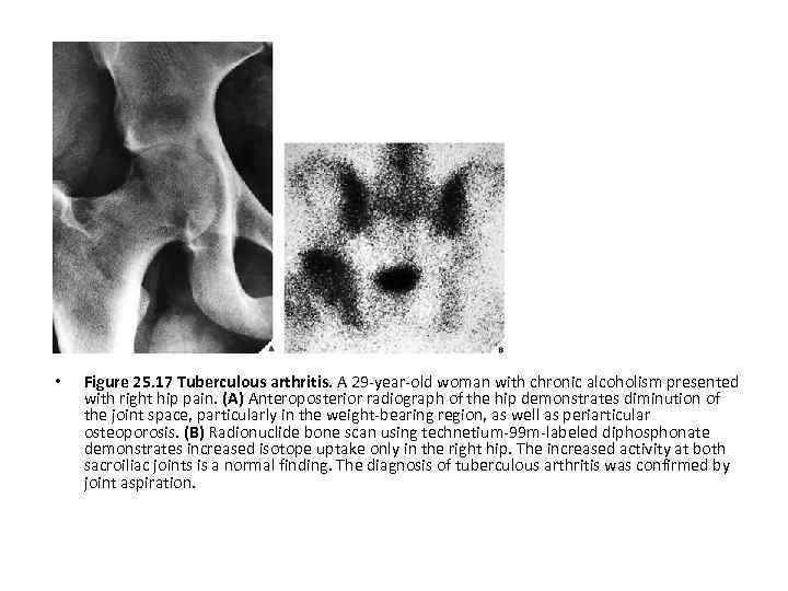  • Figure 25. 17 Tuberculous arthritis. A 29 -year-old woman with chronic alcoholism