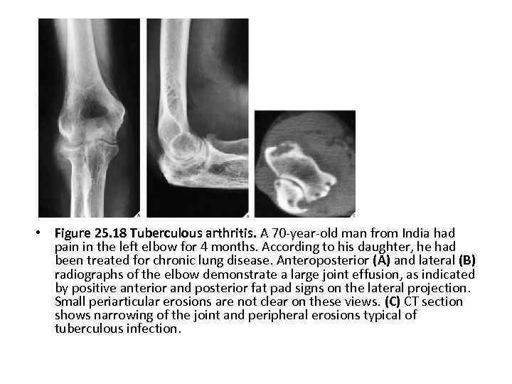  • Figure 25. 18 Tuberculous arthritis. A 70 -year-old man from India had