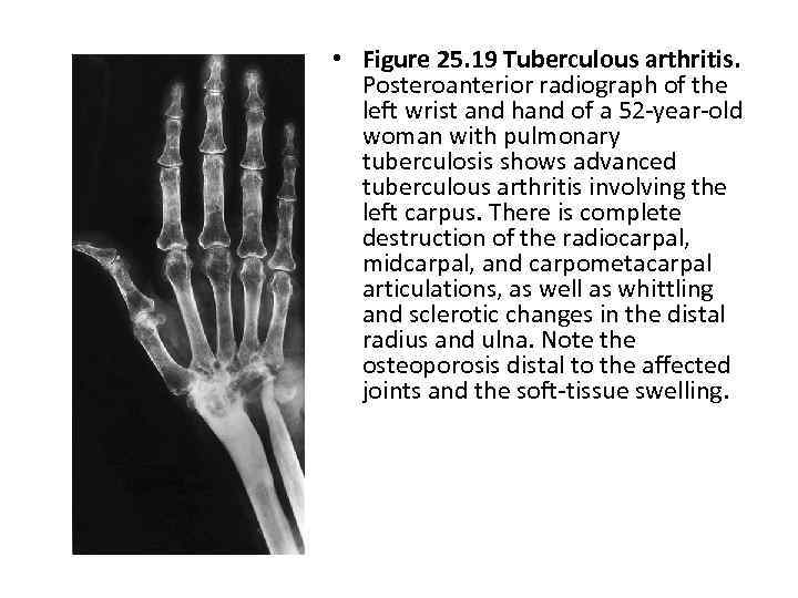  • Figure 25. 19 Tuberculous arthritis. Posteroanterior radiograph of the left wrist and