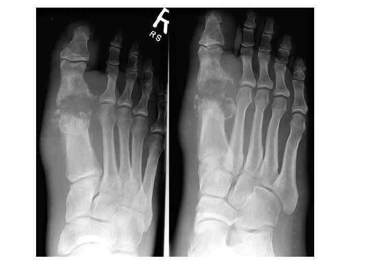 Septic arthritis and osteomyelitis, both sides of 1 st MTP joint . 